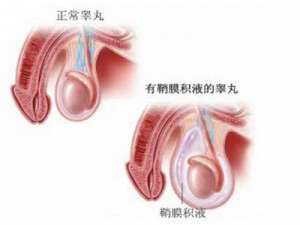 睾丸鞘膜积液预防措施有哪些